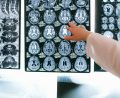 Brain injury compensation